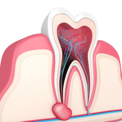 An illustration of a root canal infection