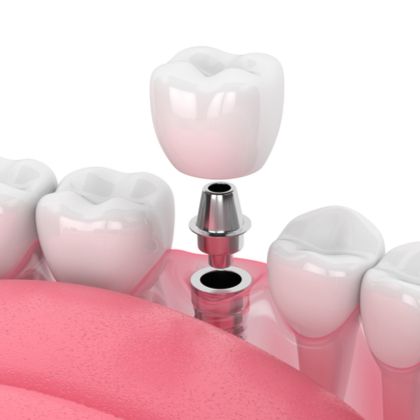 An illustration of a dental implant, abutment, and crown
